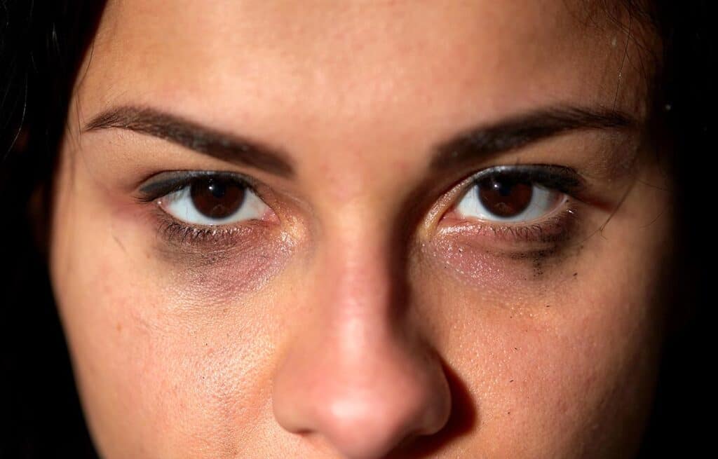 What Does It Mean If Someone Has “Meth Eyes”?