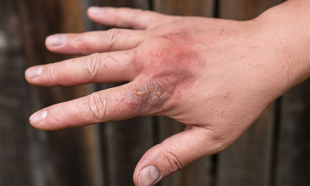 Common forms of skin damage associated with krokodil use