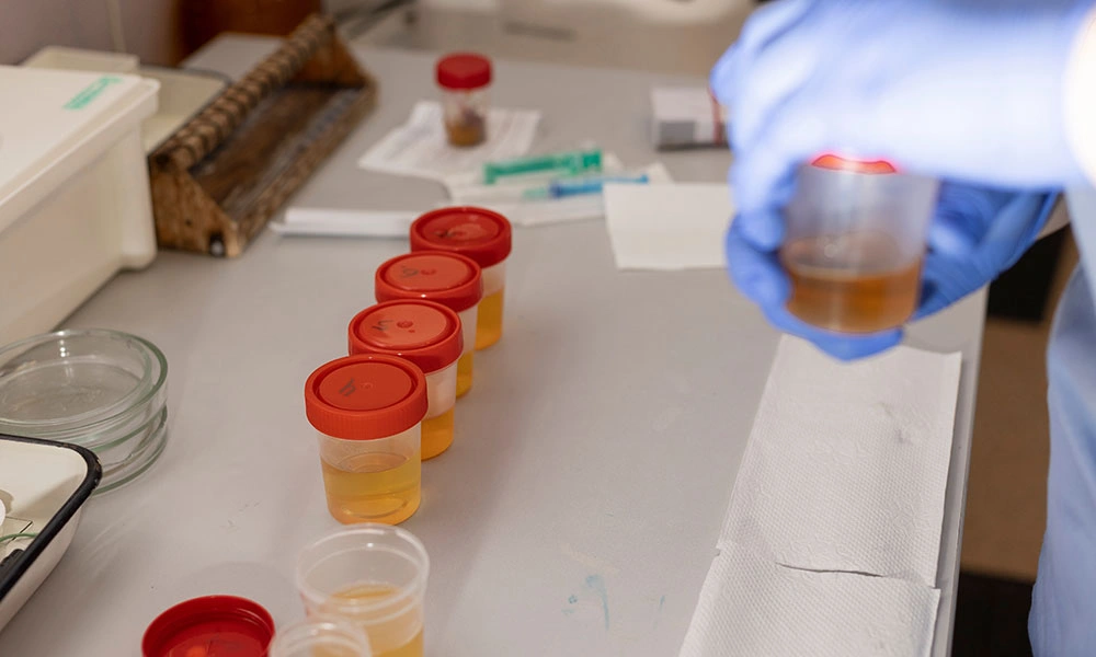 examining a urine sample for medication detection.