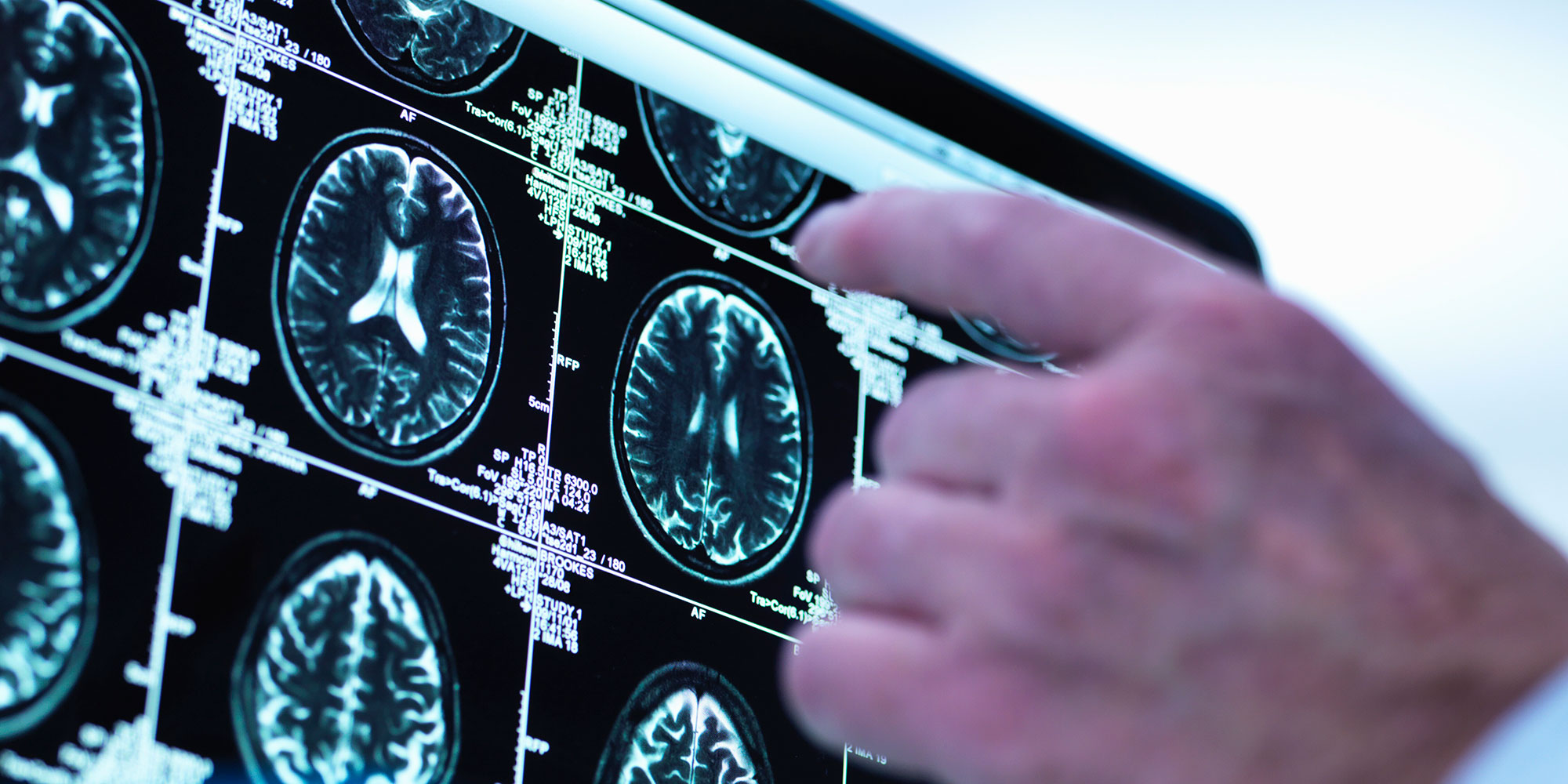 Wet brain is another way people refer to Wernicke-Korsakoff syndrome